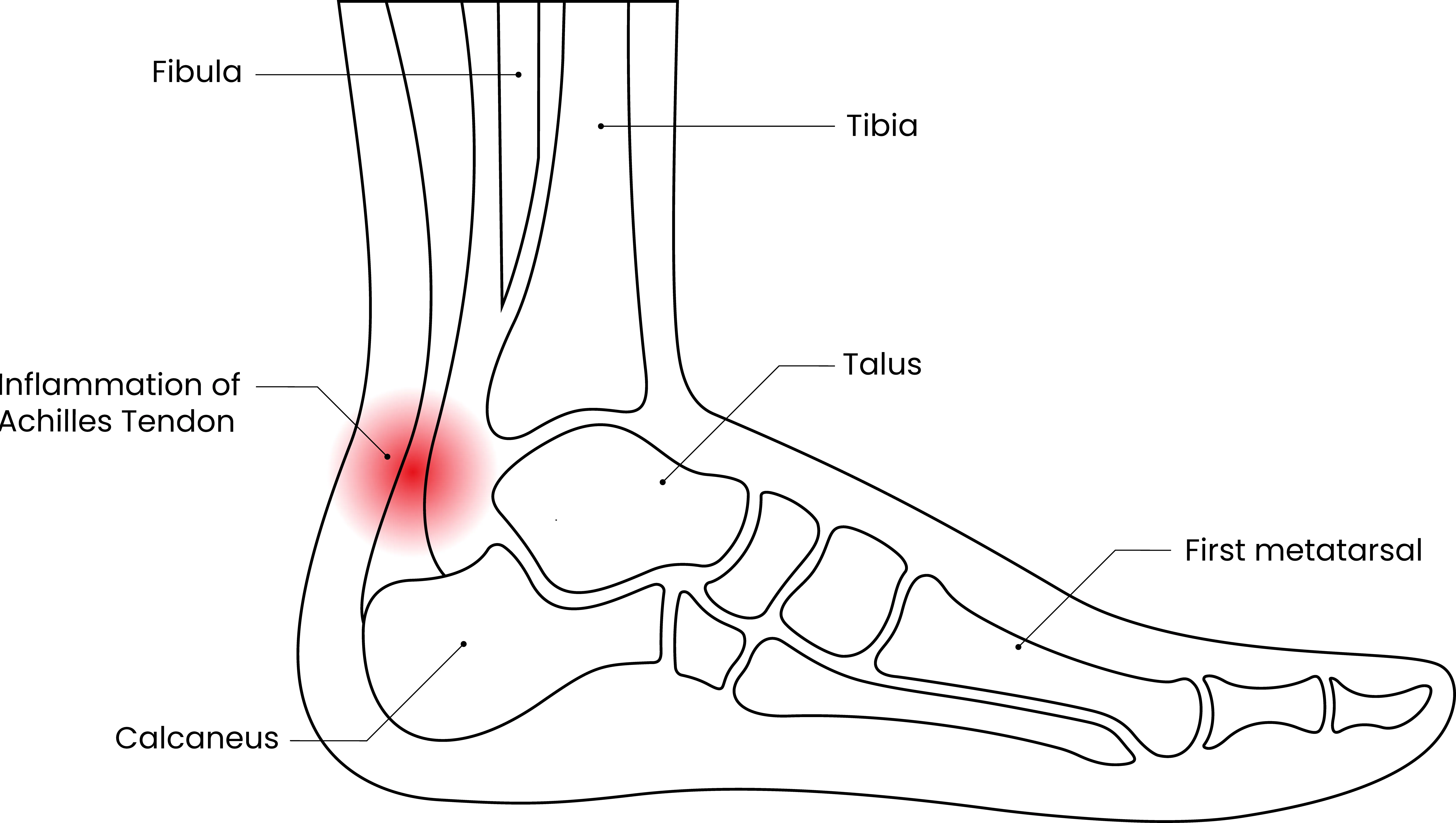 Achilles Tendinopathy
