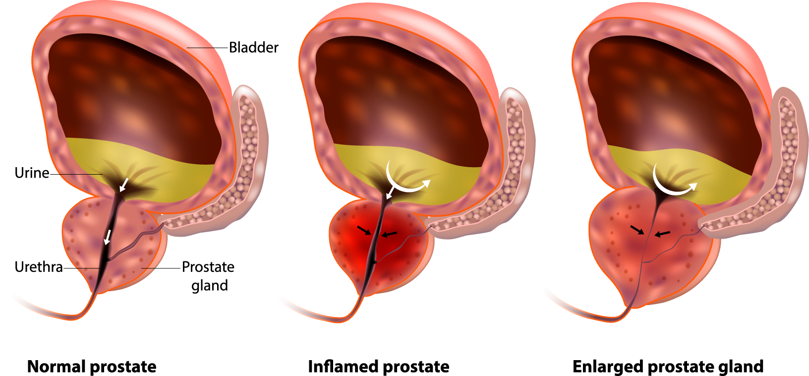 Prostate Enlargement