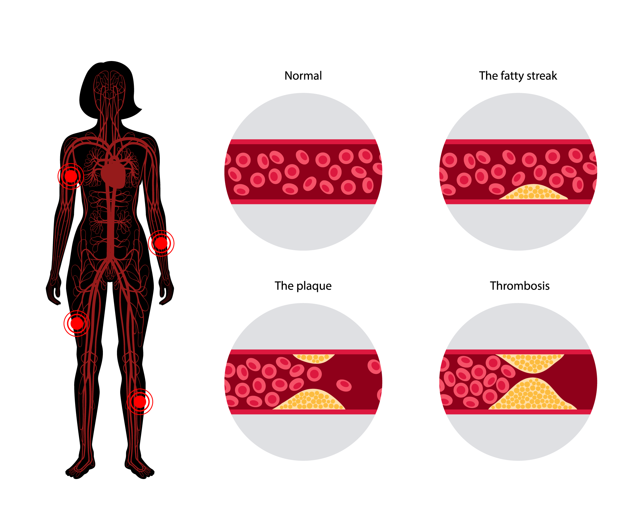 Peripheral Arterial Disease (PAD)