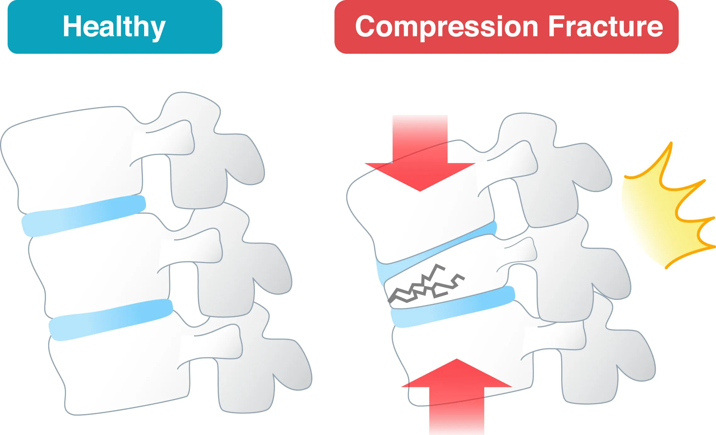 Spinal Compression Fractures